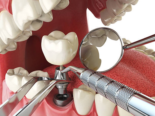 Best Broken or Cracked Tooth Emergency Dentist in Carbondale, CO